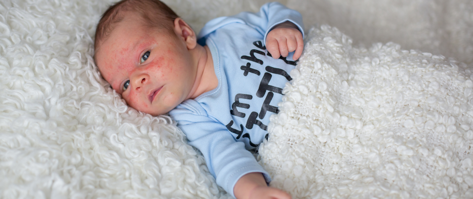 baby with rash on face and wearing blue top